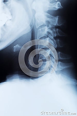 X-ray of a cervical spine