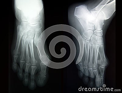 Radiography of complete foot in two projections