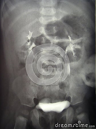 X-ray diagnostics/kidney