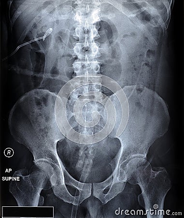 X ray film of kidney stones with ureteric stent