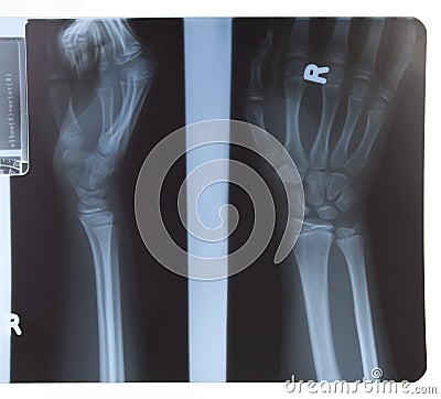 X-ray of hand and forearm