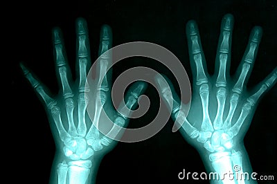 X-ray Of Hands