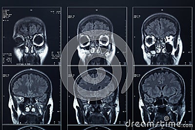 X-ray head and brain radiography