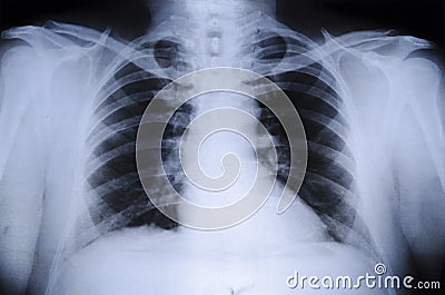 X-Ray Human Chest