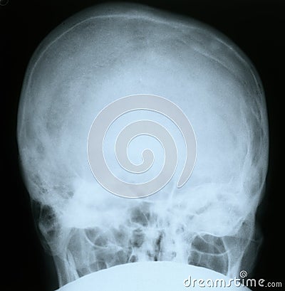 X-ray of a human skull