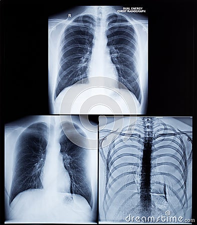 X-Ray Image Of Human Chest