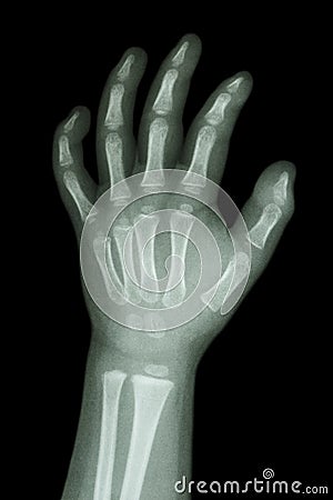 X-ray infant s hand