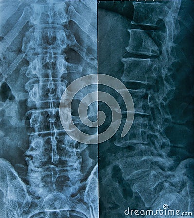 X-ray of Lumbar spine