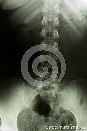 X-ray of the lumbar spine