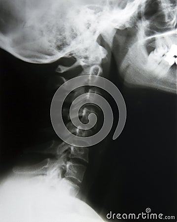 X-Ray neck