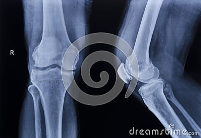 X-ray normal knee