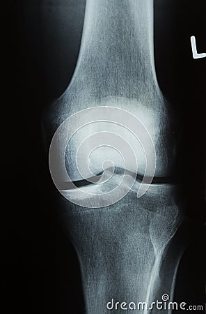 X-ray photo of a human knee