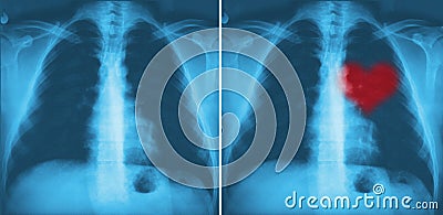 X-ray red heart of human