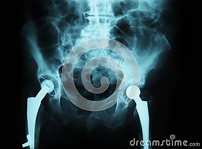 X-ray/ rtg of human pelvis - hip joint replacemen