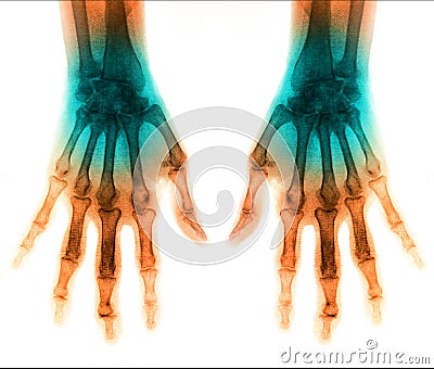 X-Ray scan human for hand