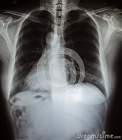 X-Ray scan human