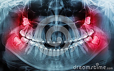 X-Ray scan human for teeth