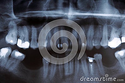 X-ray scan of humans teeth