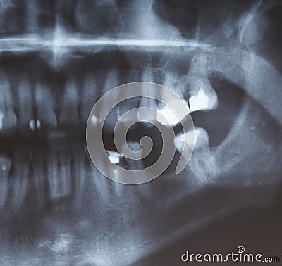 X-ray scan of humans teeth