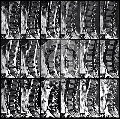 X ray of spine