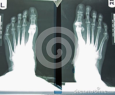 X-ray Of Woman s Foot