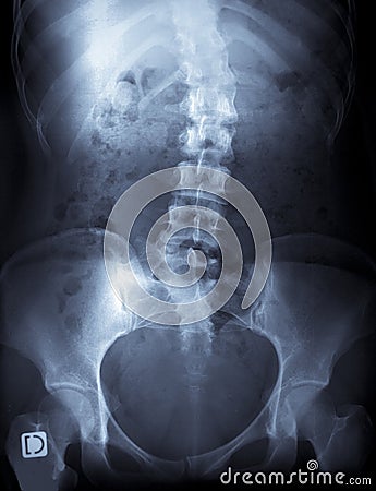 X-ray of a young female spine