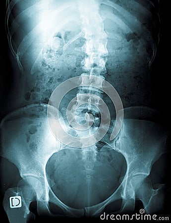 X-ray of a young female spine