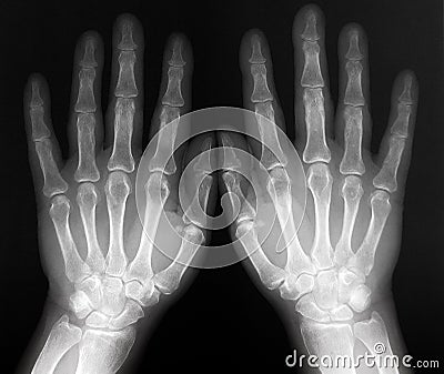 Xray of both hands - radiography