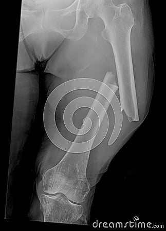 Xray of Broken Femur Bone