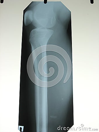 Xray of a broken leg bone
