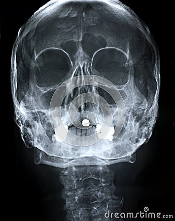 Xray/Face front