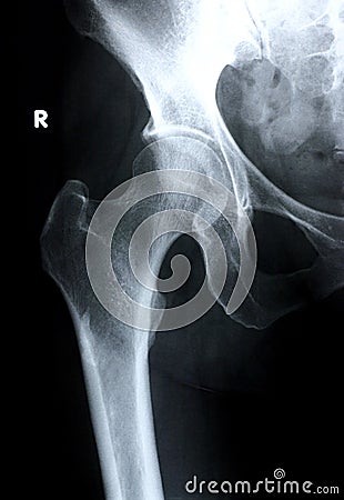 Xray/Hip Front