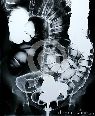 Xray large colon