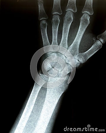 Xray of a wrist