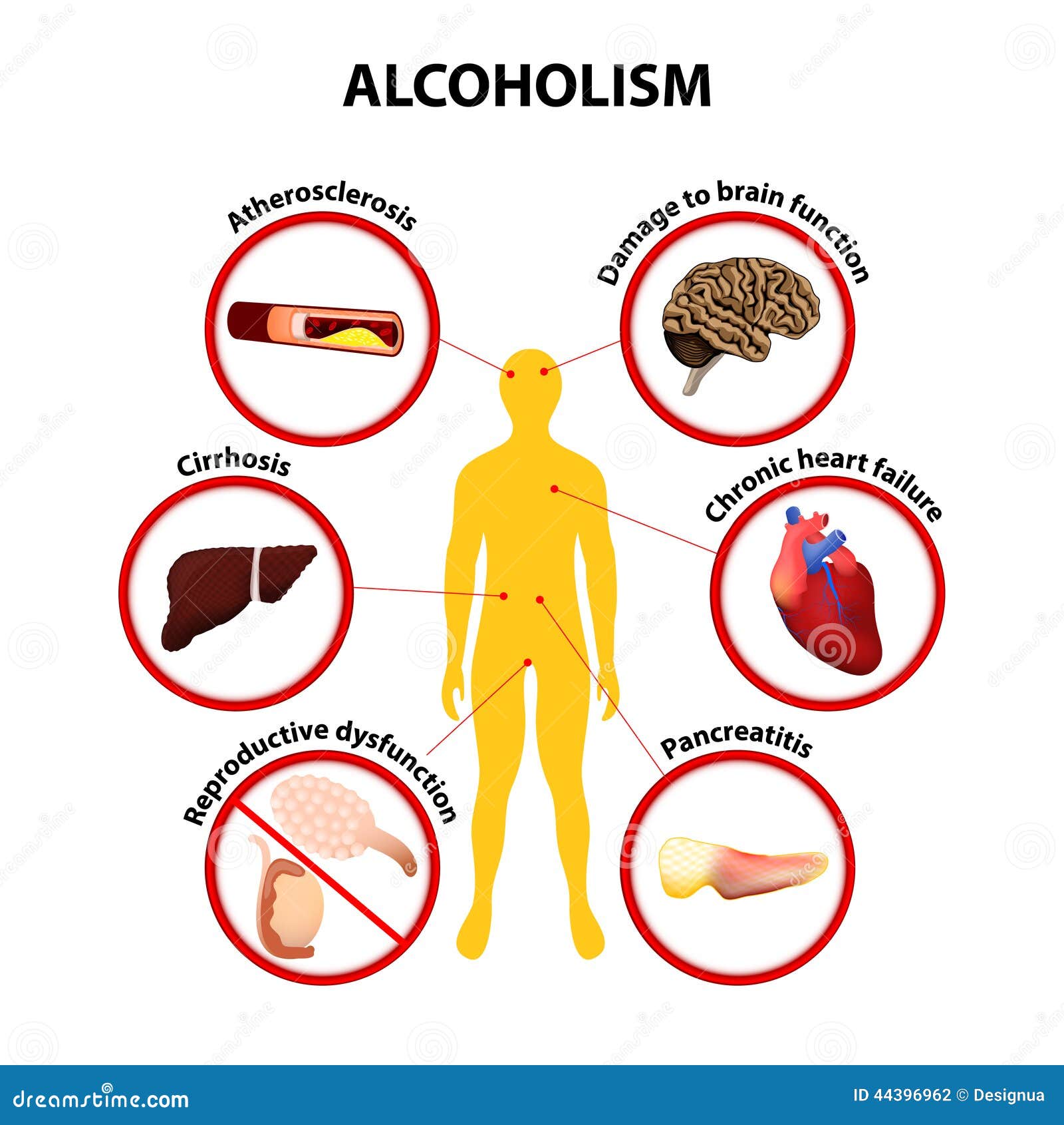 Alcoholism Infographic Stock Vector Image 44396962