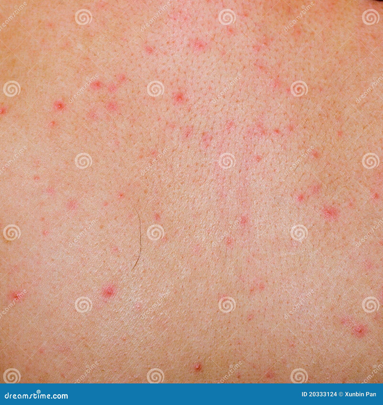 Slide show: Common skin rashes - Mayo Clinic