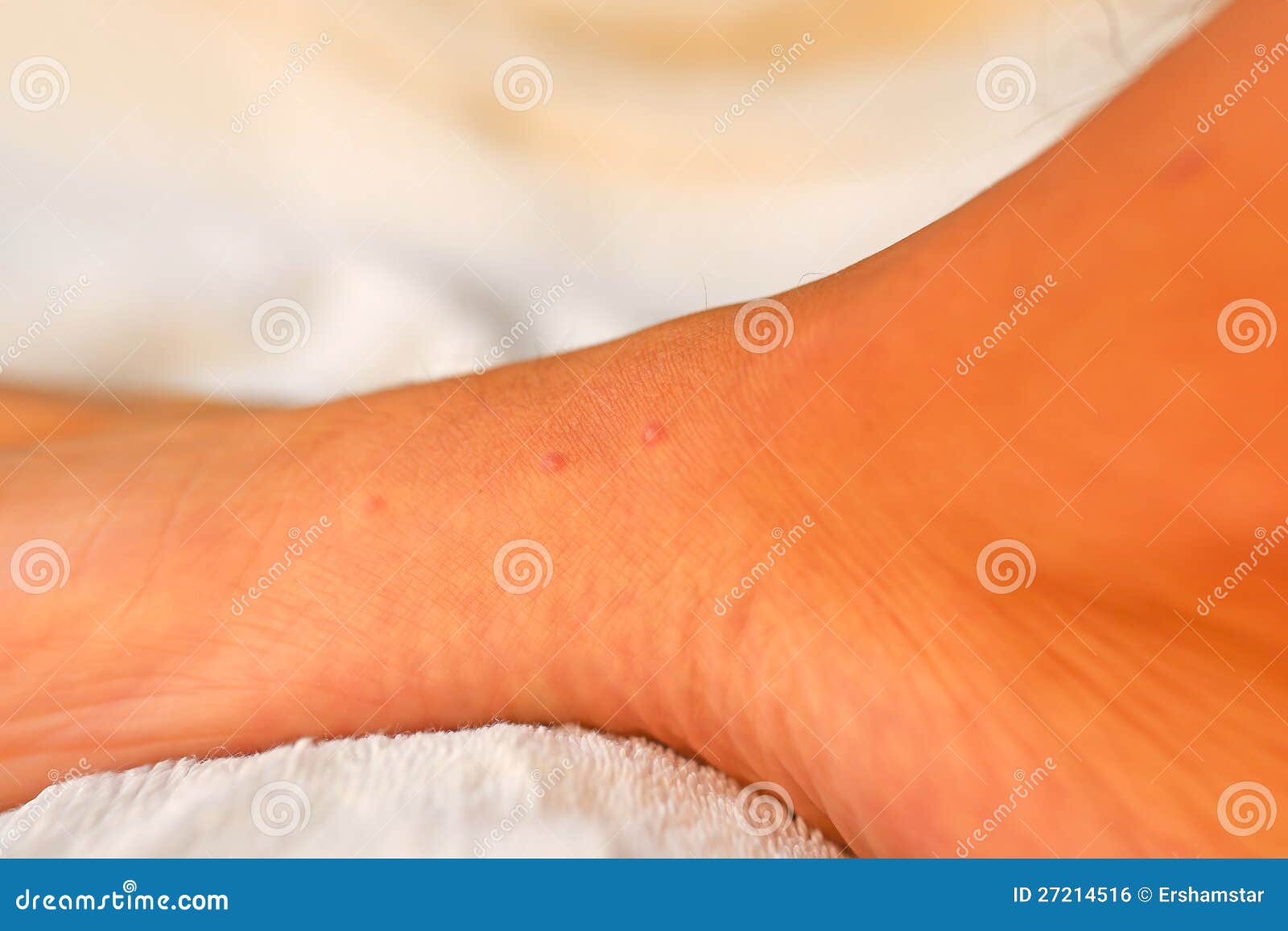 Bed bug bites on a man's foot - shallow depth of field with focus on ...