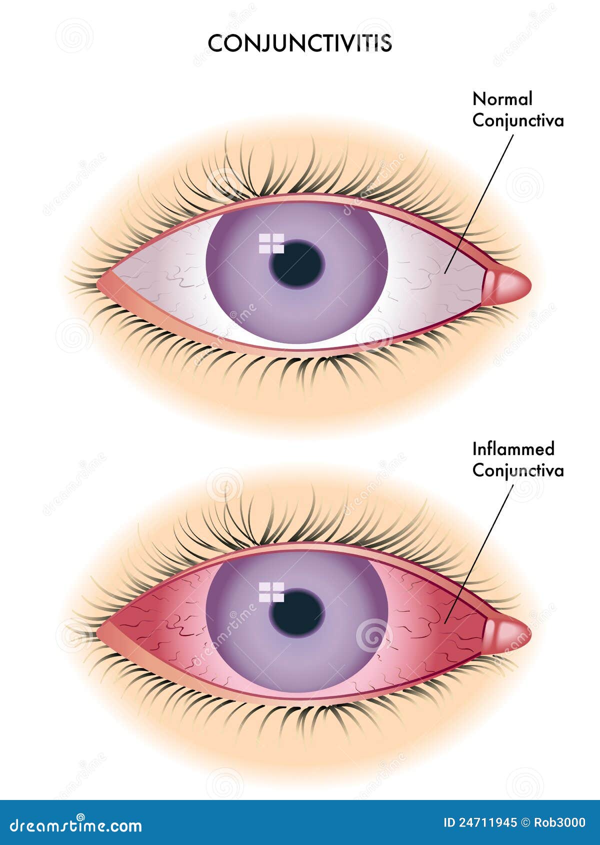 conjunctivitis, also known as pink eye - WebMD
