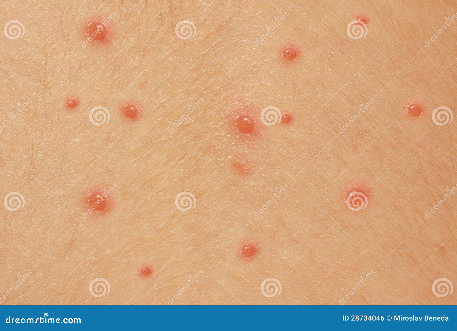 chicken pox baby pictures