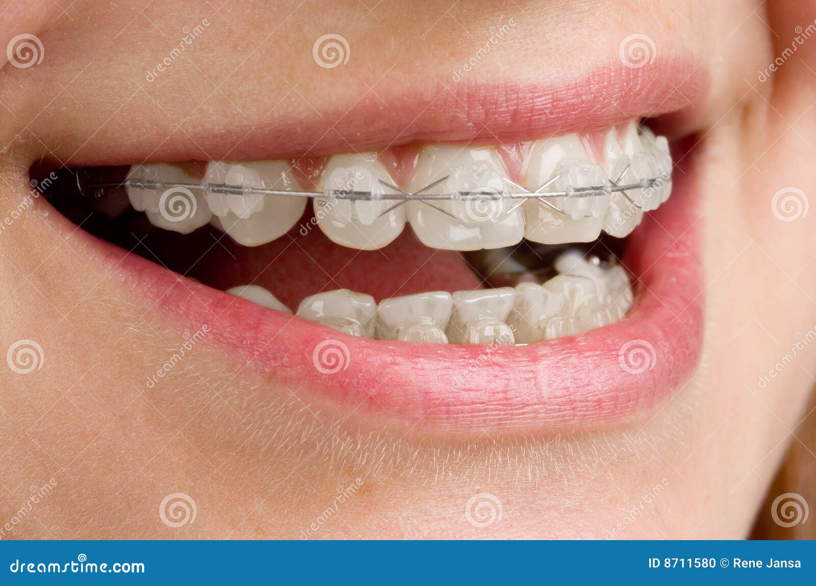 Braces On Teeth Stock Photo - Image: 8711580