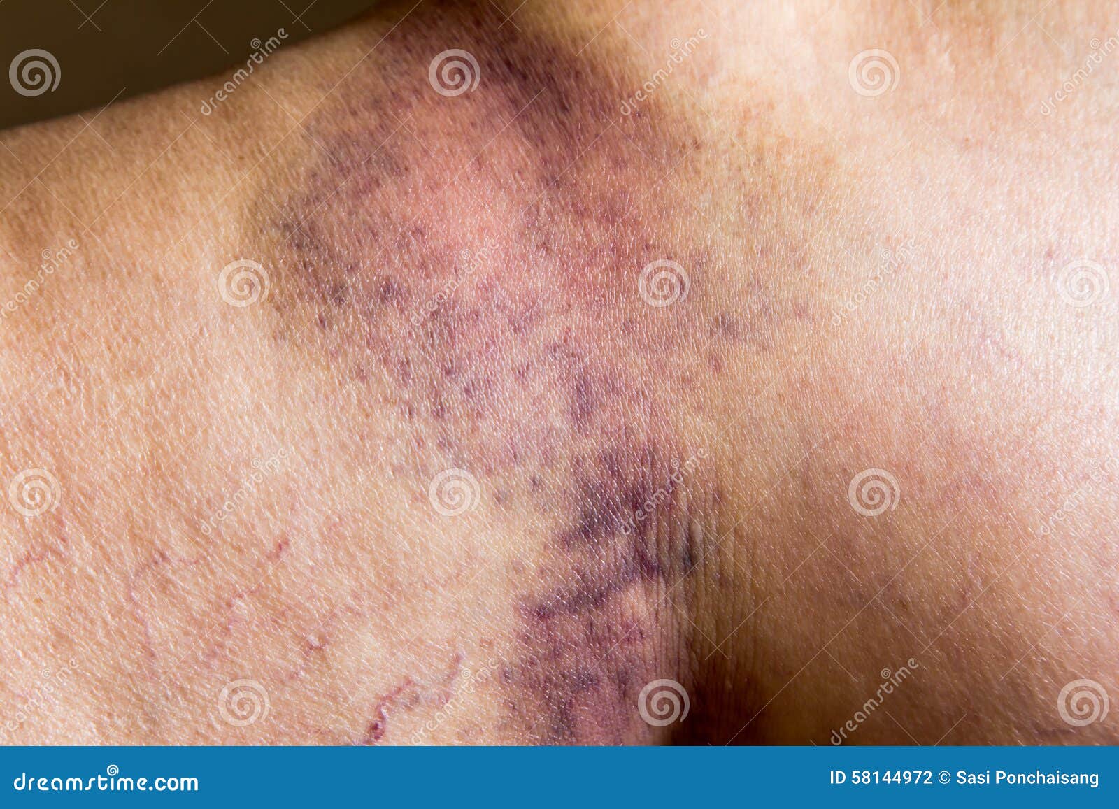 Picture Of Woman Wounded Leg 30