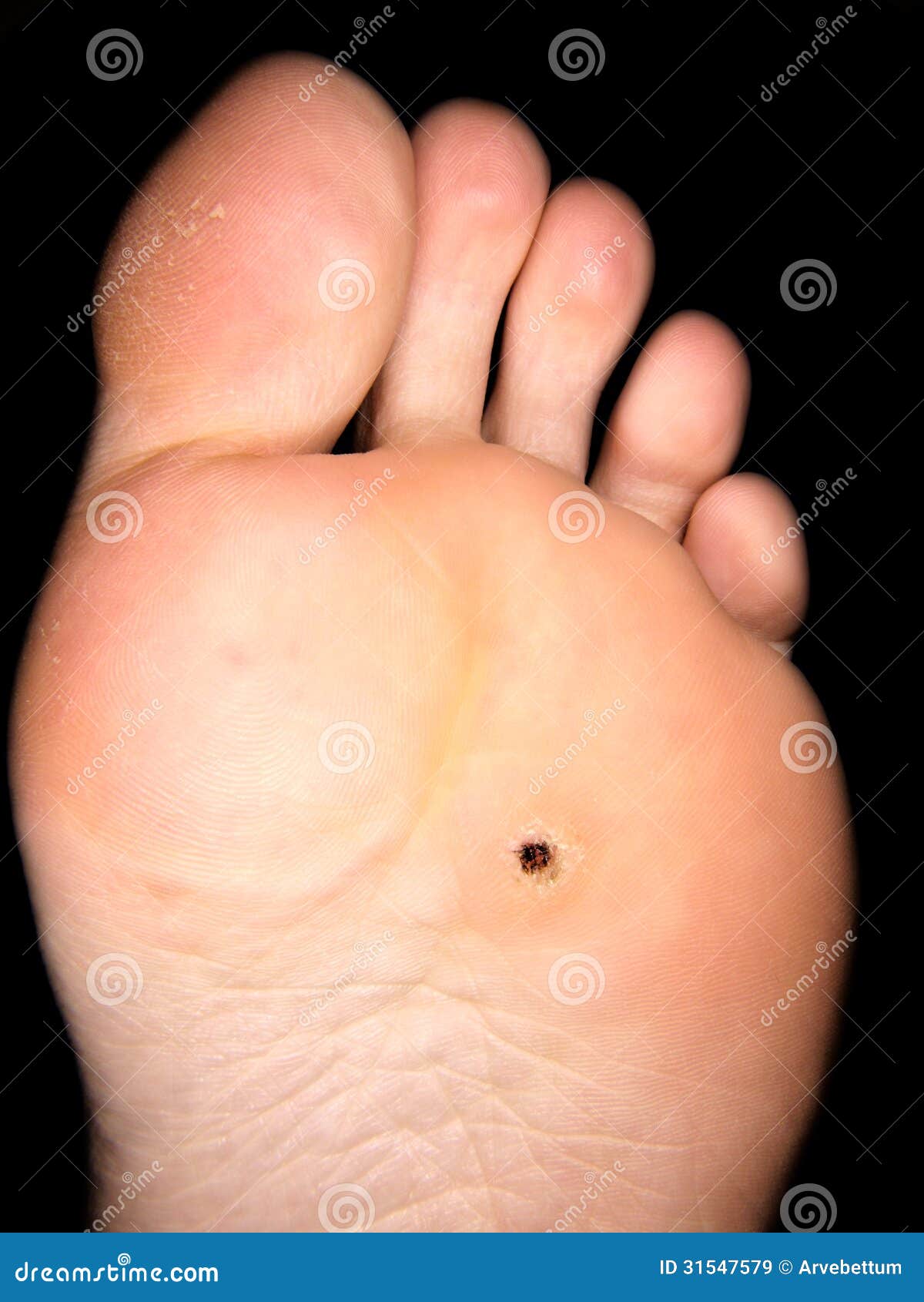 Warts on Feet - Pictures and Treatments for Foot Warts