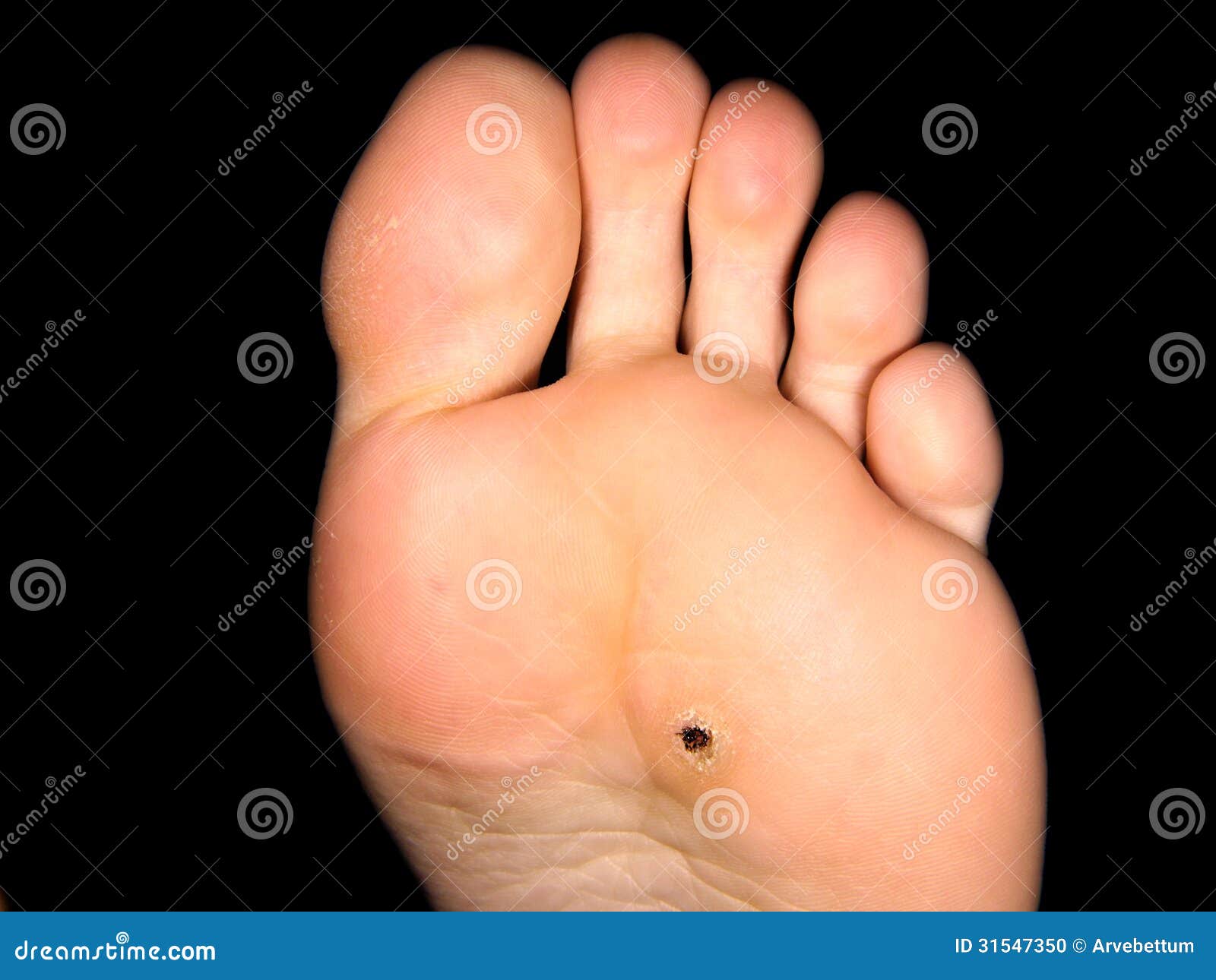 foot callus file