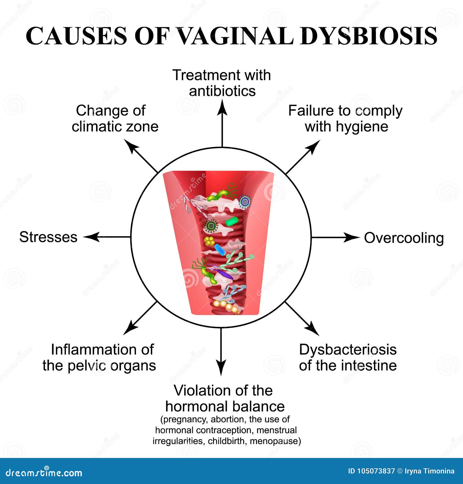 Causas De Disbiosis Vaginal Vaginitis Candidiasis Infograf A Hot Sex