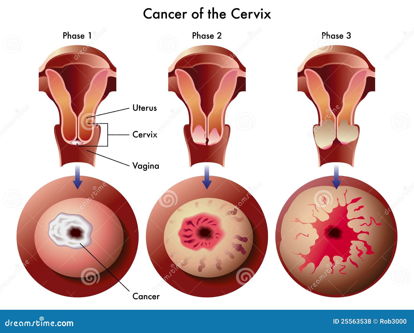 Endometrial most cancers figo grade 1 endometrial most cancers signs and symptoms