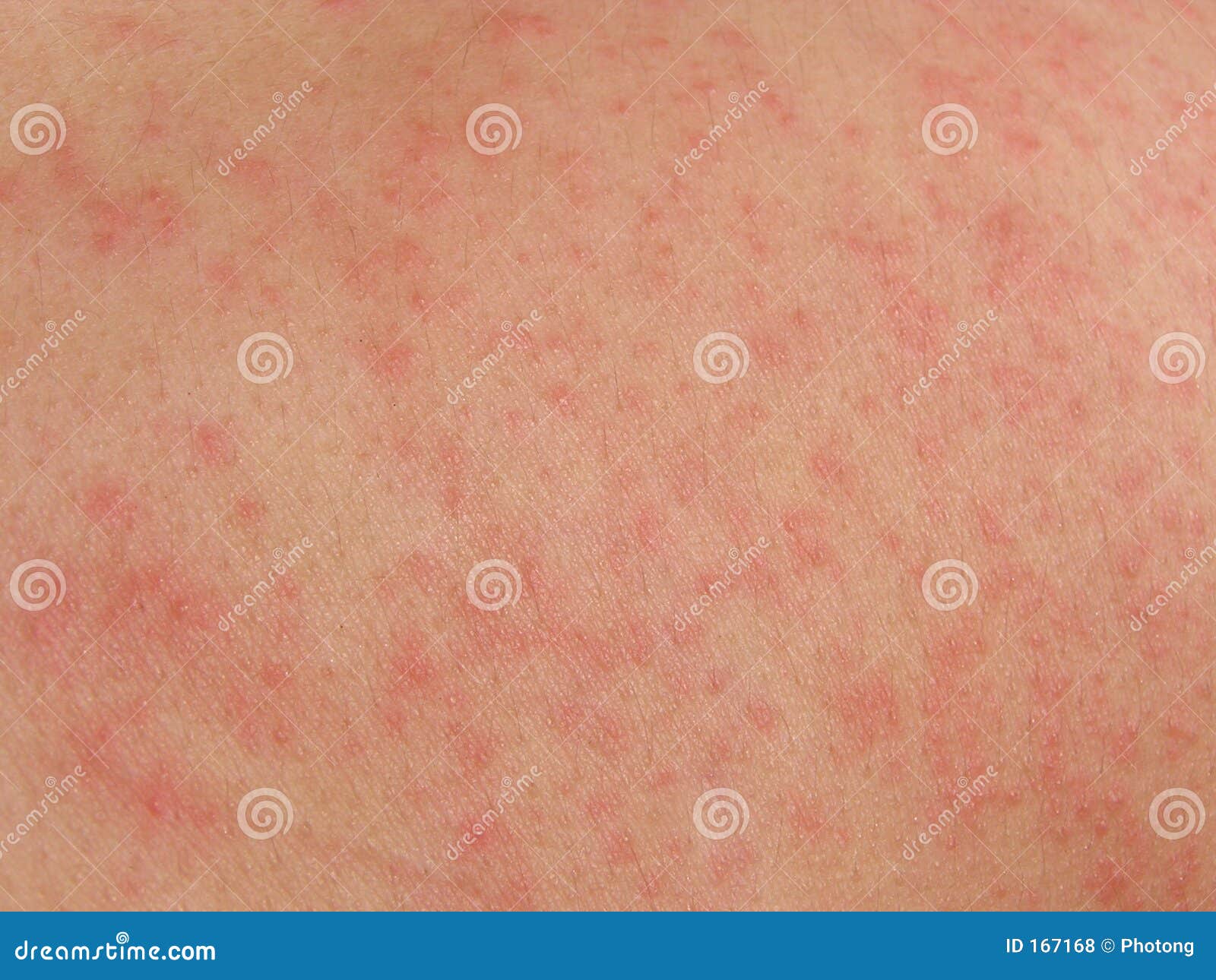 Pictures of Viral Skin Diseases and Problems - Herpes Zoster