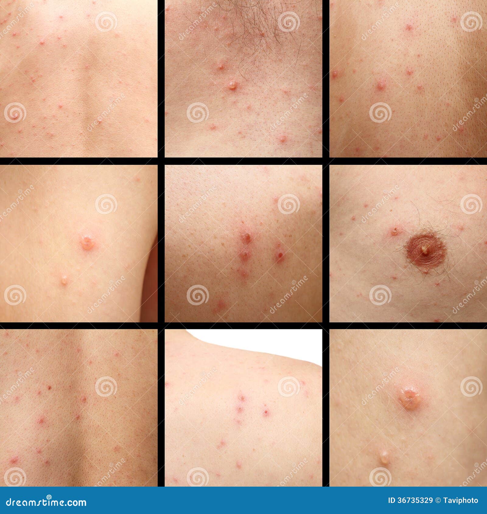 Chicken Pox On Human Skin Royalty Free Stock Images Image 36735329