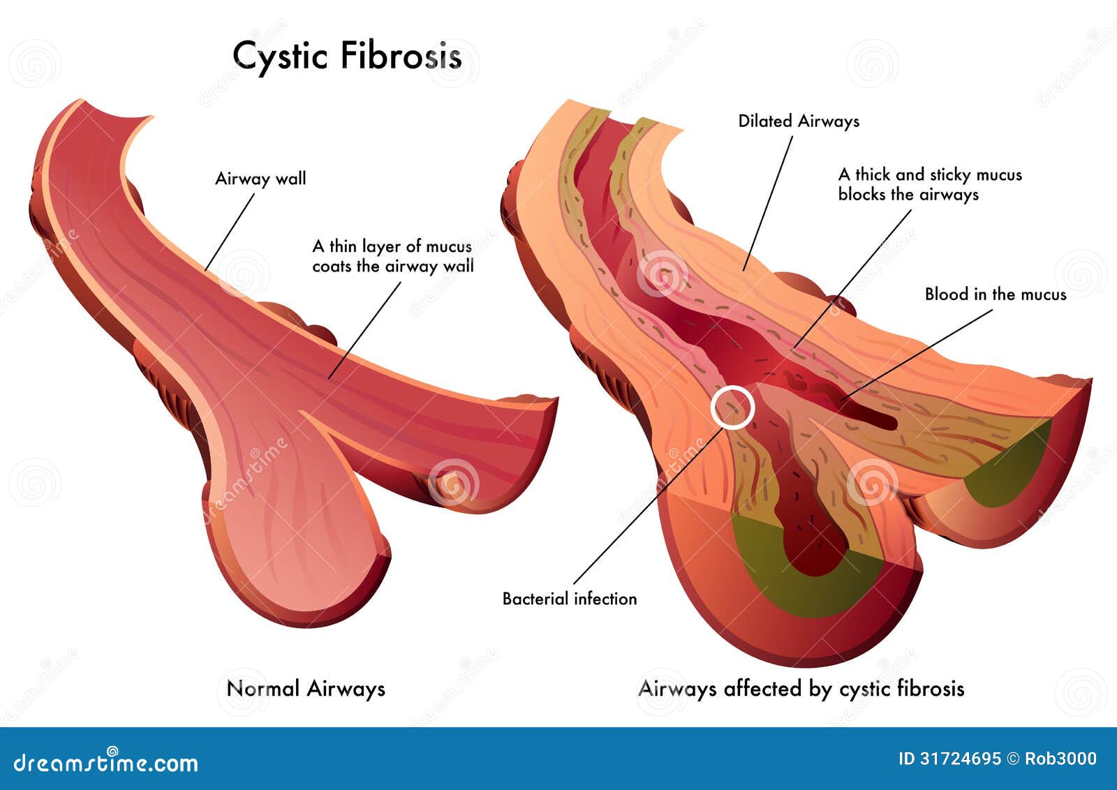 CYSTIC FIBROSIS Royalty Free Stock Photo - Image: 31724695