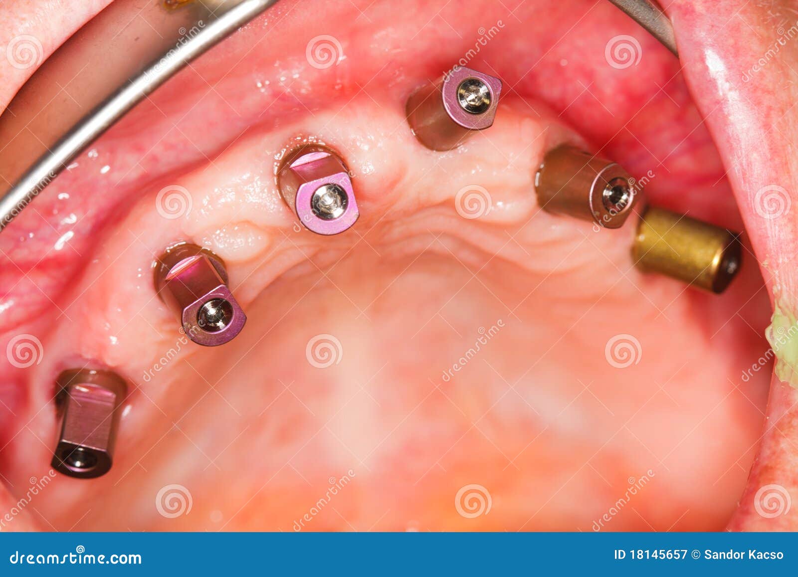 Dental Implants With Impression Posts Royalty Free Stock Photography