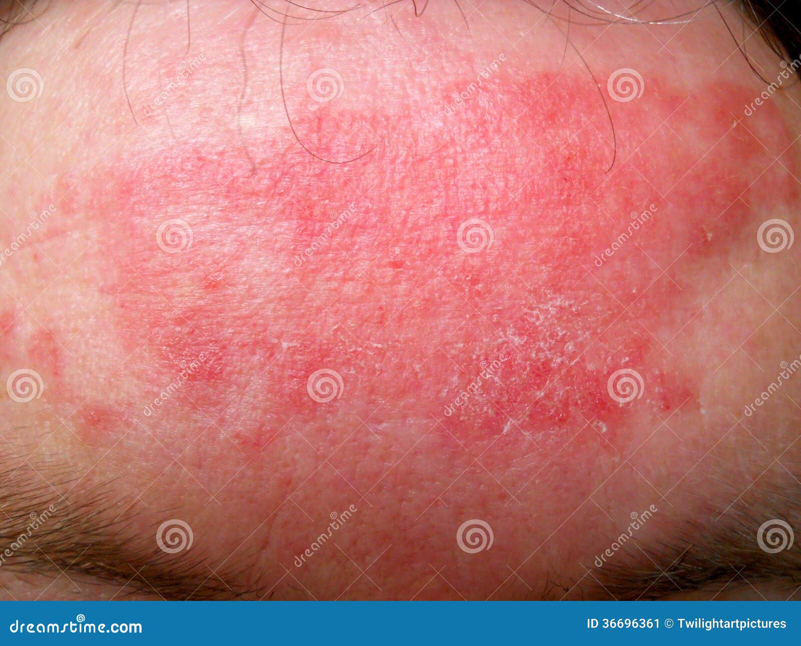 eczema forehead